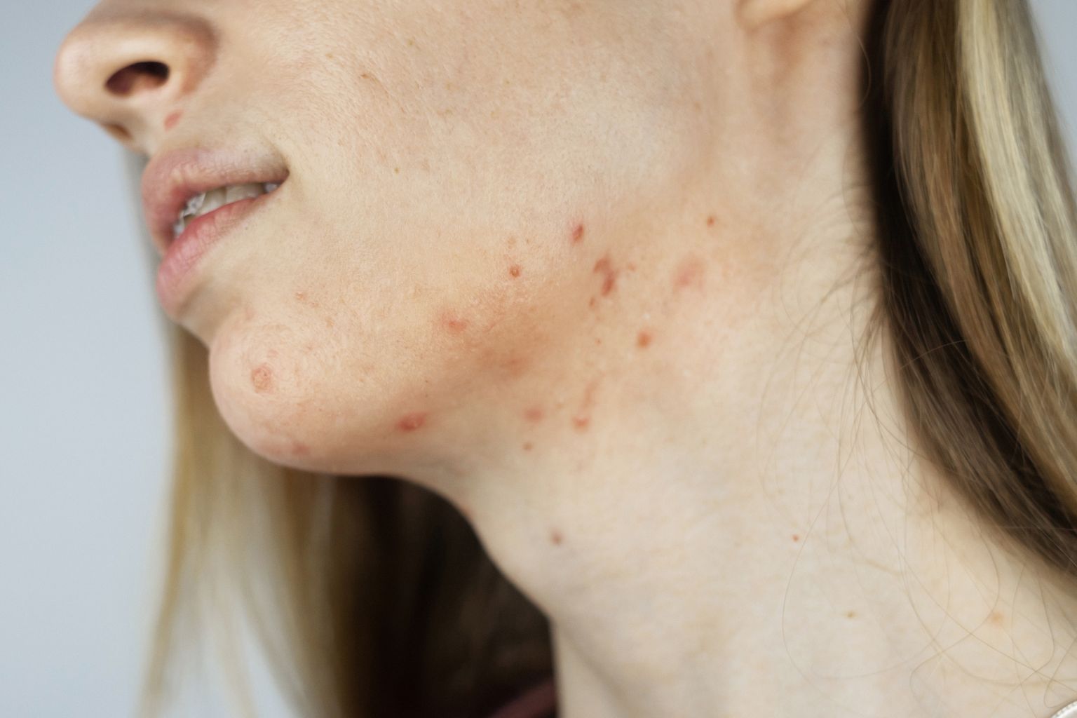 Жінка з ознаками демодекозу на шкірі обличчя